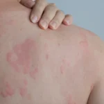 Алерген-специфічна терапія: як працює вакцина проти алергії?